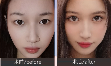 埋線雙眼皮案例